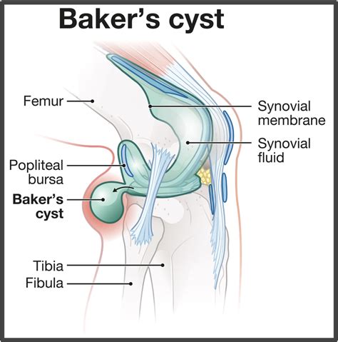 Baker's Cyst Cpt