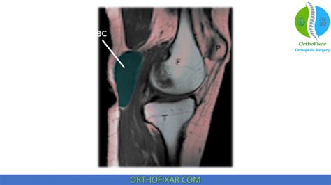 Baker's Cyst Decompression Cpt