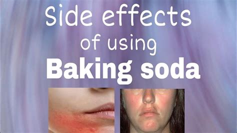 Baking Soda Sitz Bath Side Effects