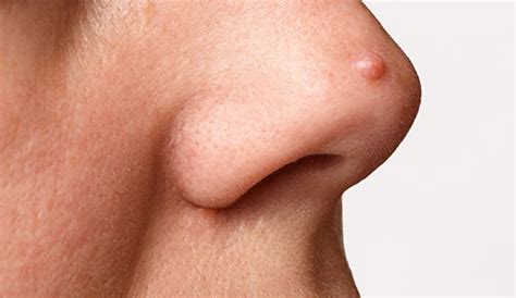 Ball Inside Tip Of Nose