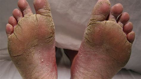 Ball Of Foot Keeps Cracking