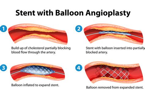 Balloon Catheter Stent Insertion