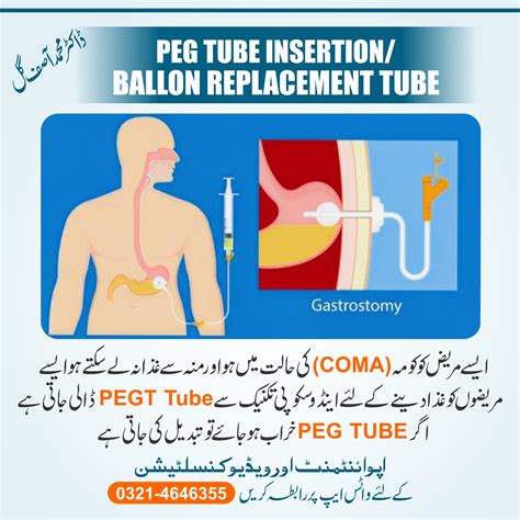 Balloon Gastrostomy Vs Peg