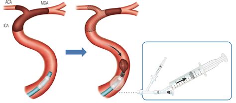 Balloon Guide Catheter Thrombectomy