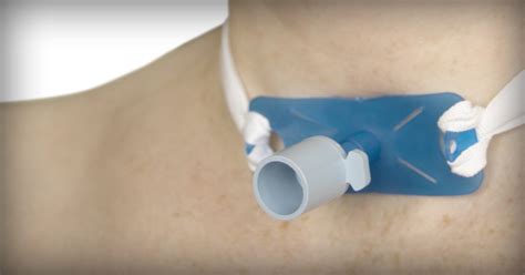 Ballpoint Pen Tracheotomy