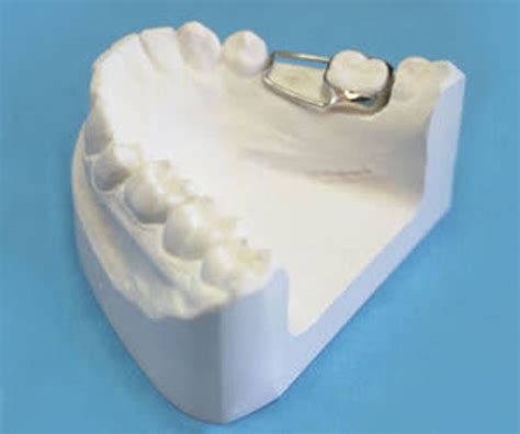 Band And Loop Space Maintainer Dental Code