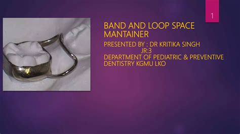 Band And Loop Space Maintainer Wire Size