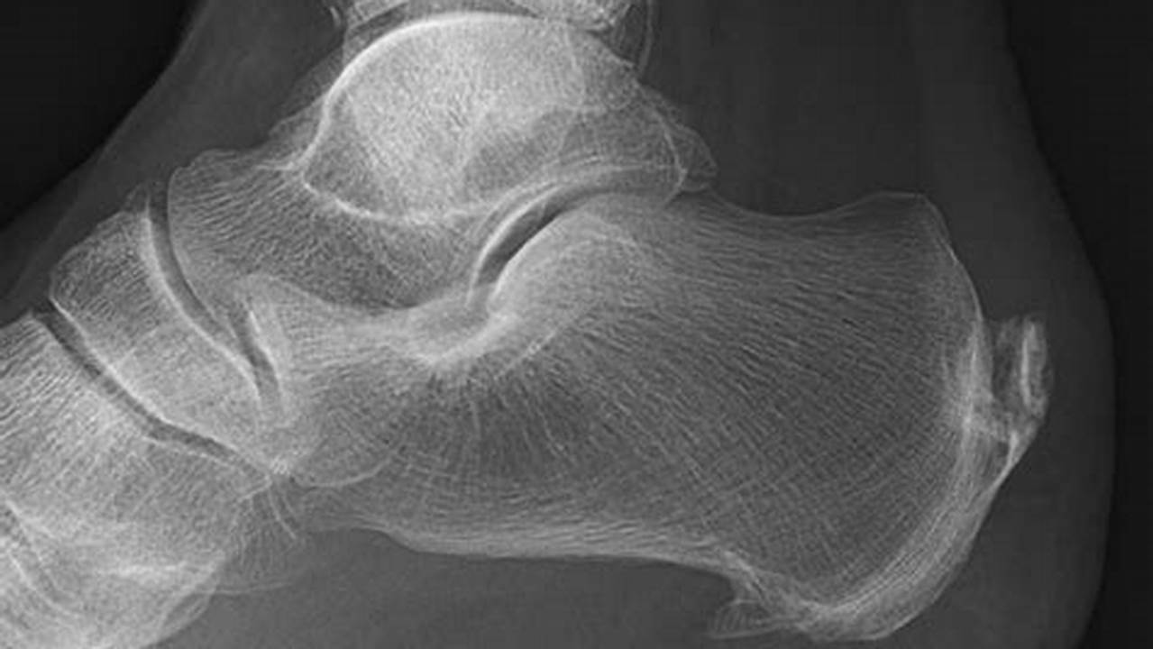 Barbotage Procedure for Bone Spurs