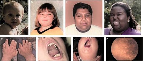 bardet biedl syndrome genetics