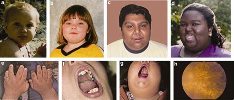 bardet-biedl syndrome type 1