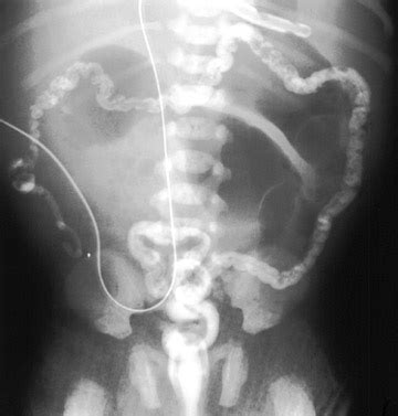 barium enema cpt code