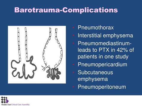 Barotrauma In Mechanical Ventilation