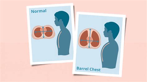Barrel Chest Reason