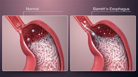 barrett's esophagus surgery