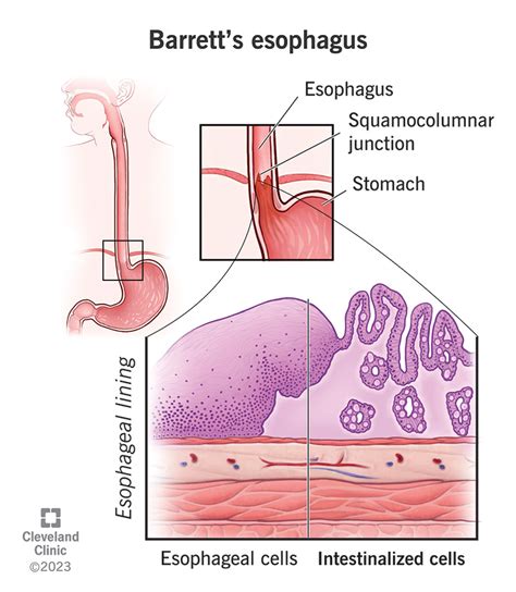 Barrett Esophagus Cells