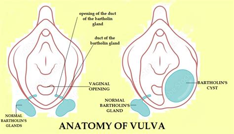 Understanding Bartholin Cyst Location and Its Complications