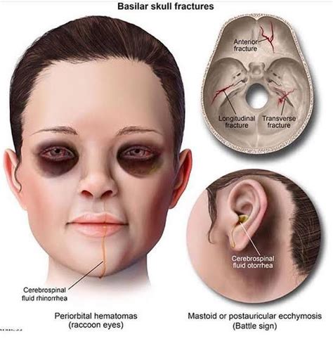 Basal Skull Fracture Features