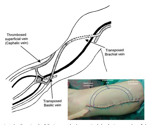 Basilic Vein Elevation Cpt Code