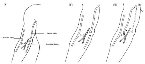 Basilic Vein Ligation Cpt Code