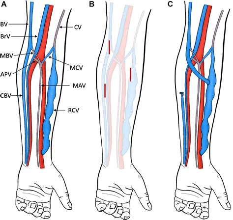 Basilic Vein Venous Cpt Code