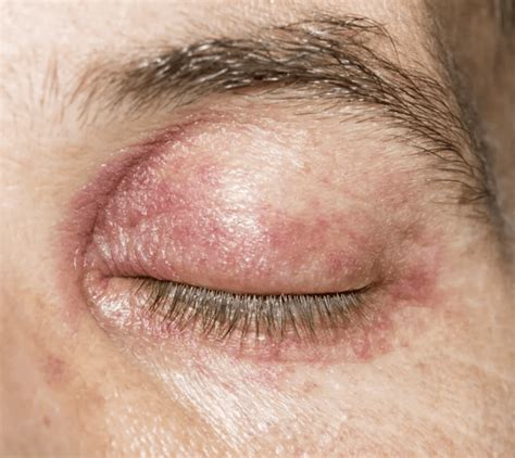 Bat An Eyelid Example