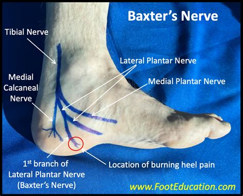 Baxter's Nerve Causes