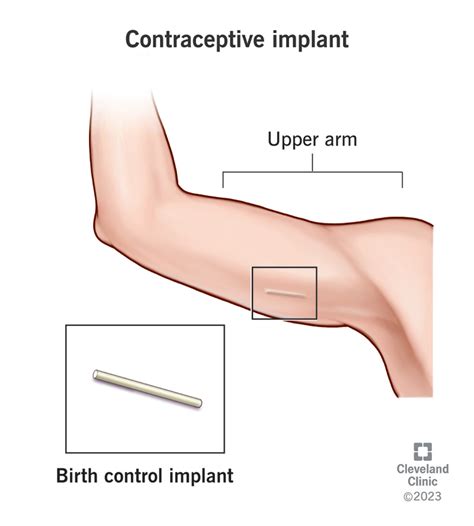 Revolutionizing Birth Control: The Benefits and Procedure of BC Implant Arm