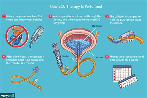 bcg treatment side effects