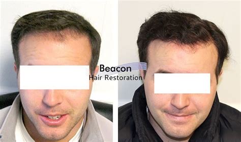 Results Beacon Hair Restoration Dublin