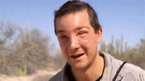 bear grylls swollen face