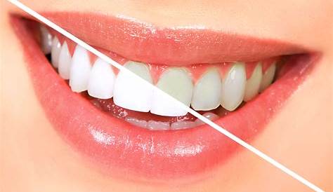 Beaut Teeth Whitening Review