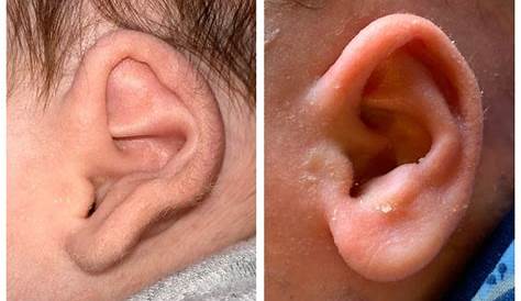 Bebeklerde Kepçe Kulak Tedavisi