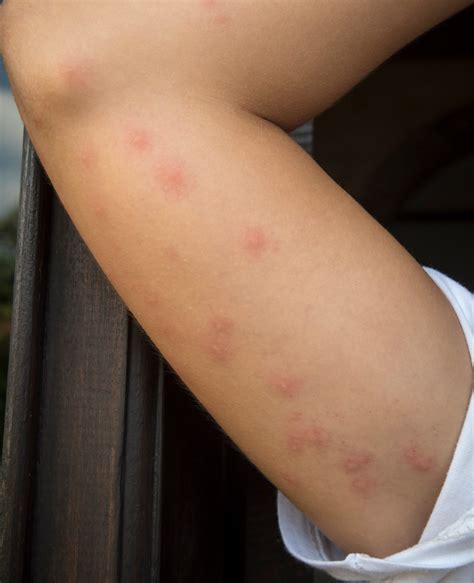 Bed Bug Bites Itch More At Night