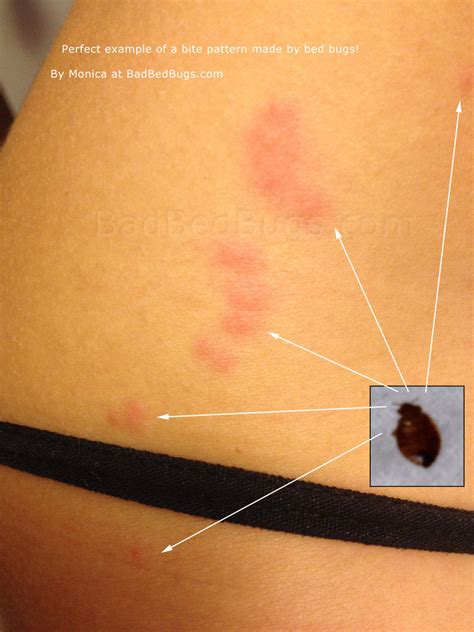 Bed Bug Bites Pattern