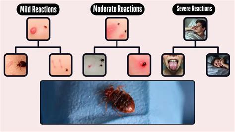 Bed Bug Bites Reaction