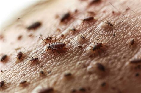 Bed Bug Multiple Bites