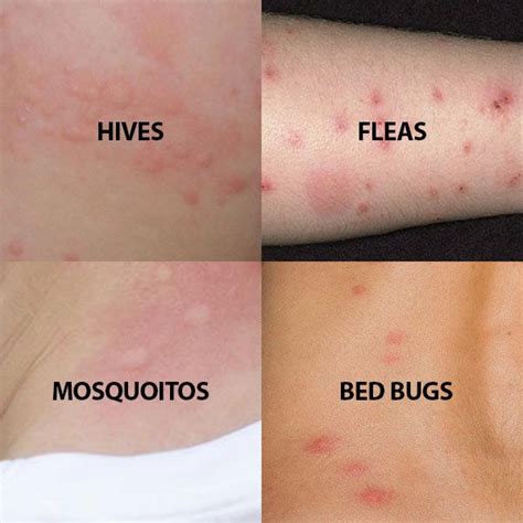 Bed Sheets Causing Hives