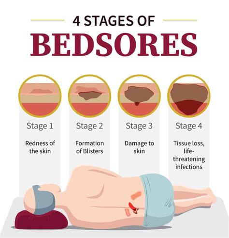 Bedsores Exercise