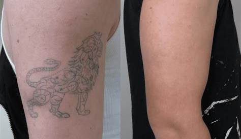 Before And After Of Tattoo Removal Treatment Treatment