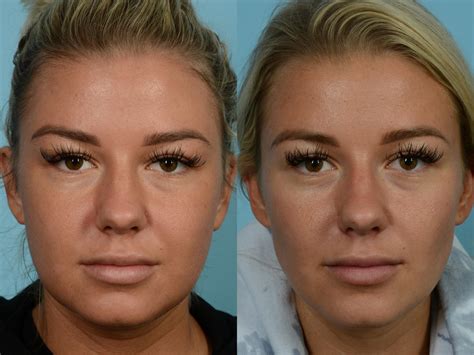 before and after buccal fat removal