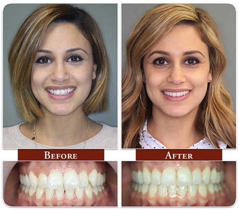 before and after dentist