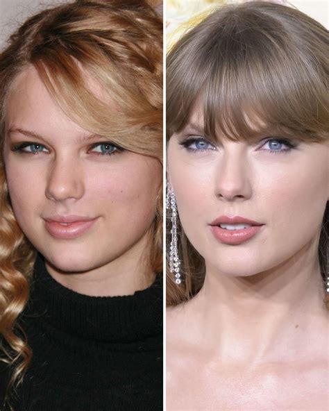 Taylor Swift Plastic Surgery With Before And After Photos