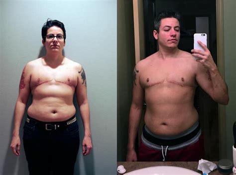 before and after top surgery