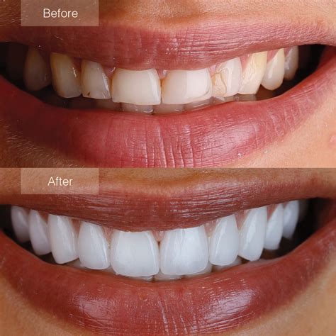before and after veneers teeth