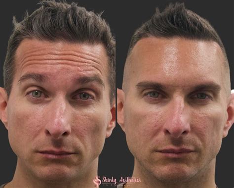 Botox Forehead and Brows Synchronized Before & After YouTube