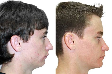 Deep Bite Correction Invisalign Before and After YouTube
