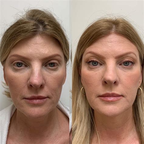Face Exercise Before and after pictures 102615 YouTube