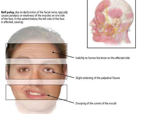 bell's palsy and ear pain