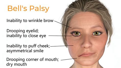 bell's palsy decreased sensation