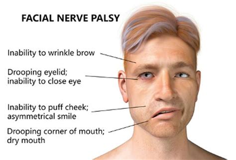 bell's palsy facial pain
